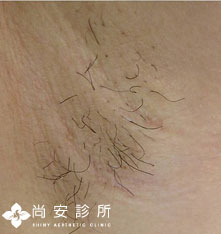 雷射除毛-腋下除毛前