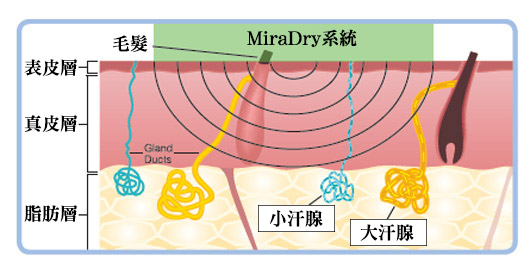 MiraDry腋淨爽系統