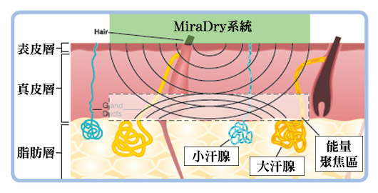 MiraDry腋淨爽療效