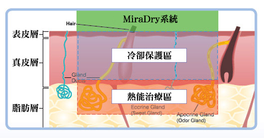 MiraDry腋淨爽效果示意