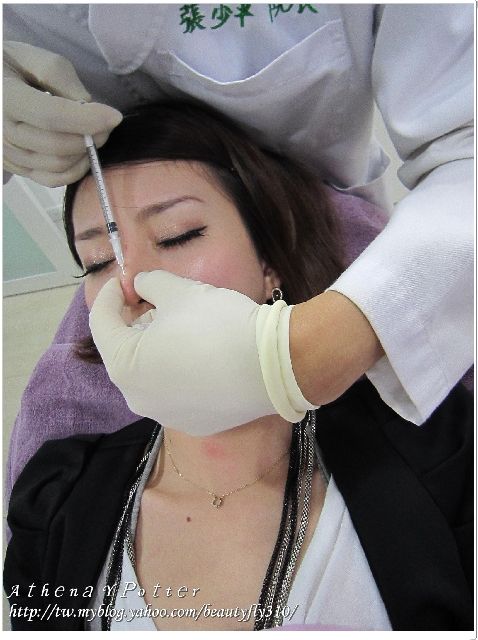 微晶瓷隆鼻過程07