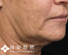 電波拉皮前1