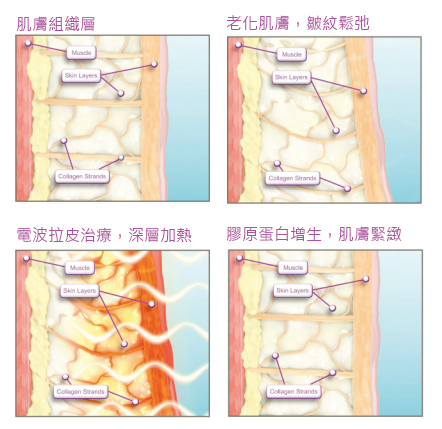 電波拉皮效果