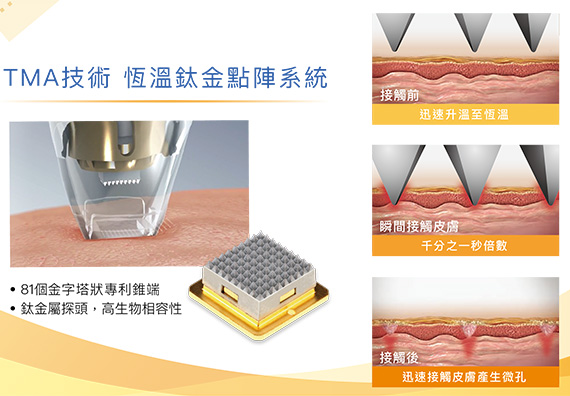提可塑優勢：TMA技術 恆溫鈦金點陣系統