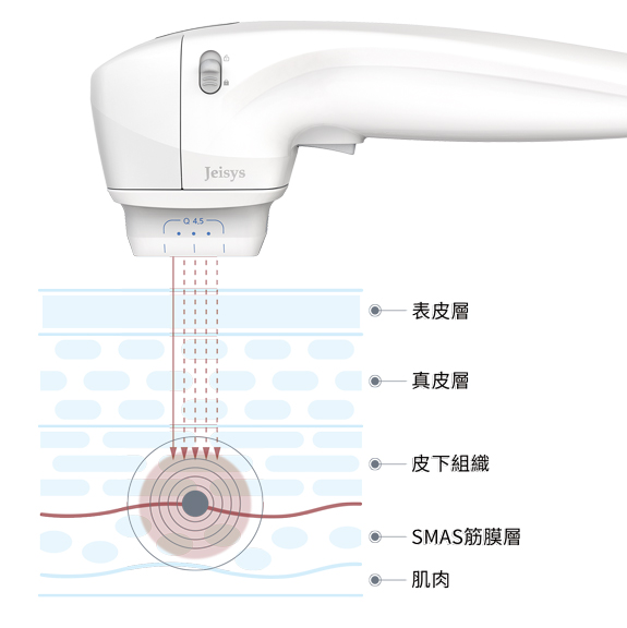 Q+立線音波作用皮層