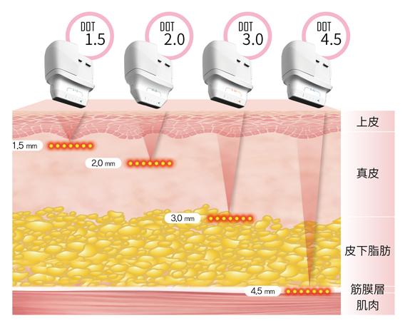 Q+立線音波點狀探頭皮層