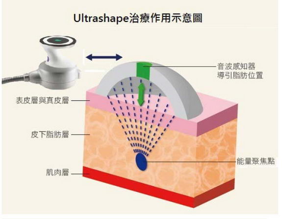 UltraShape歐萃學超音波作用