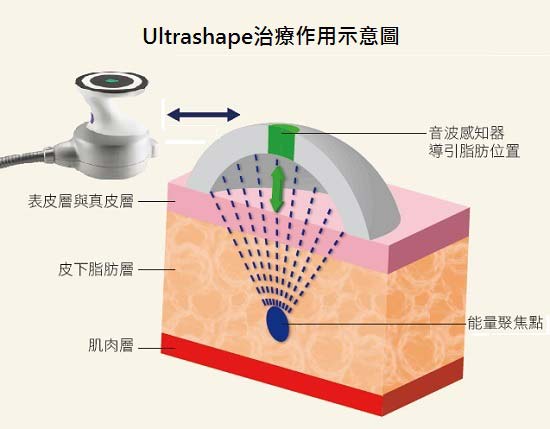 標靶震波溶脂效果