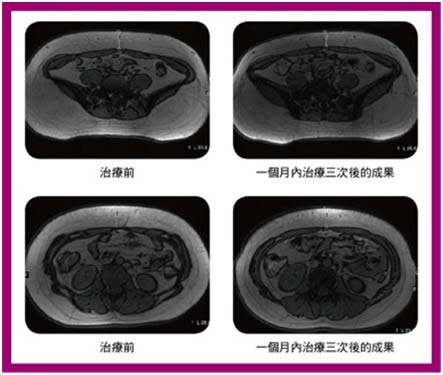 標靶震波溶脂效果紀錄