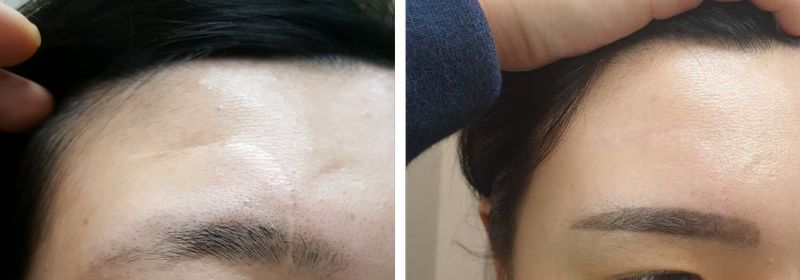 薇貝拉臉部改善
