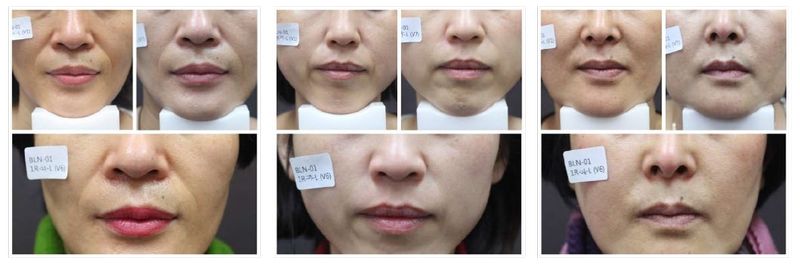 薇貝拉法令紋淡化