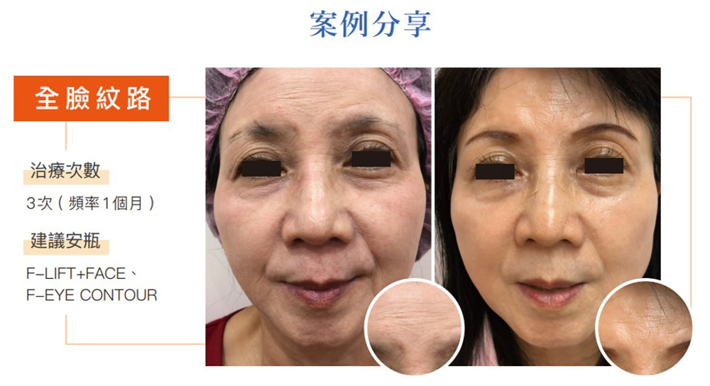 提可塑撫平全臉紋路效果