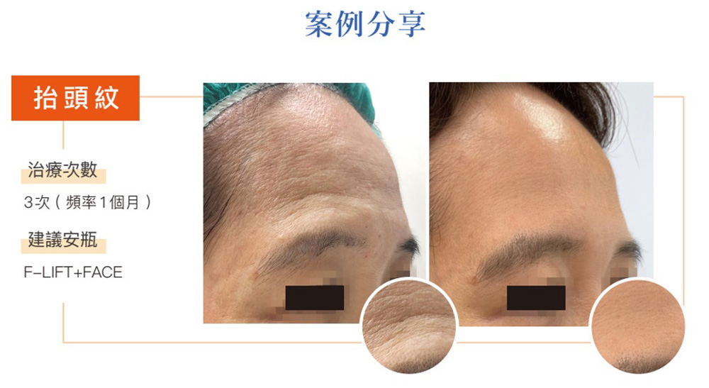 提可塑改善抬頭紋效果