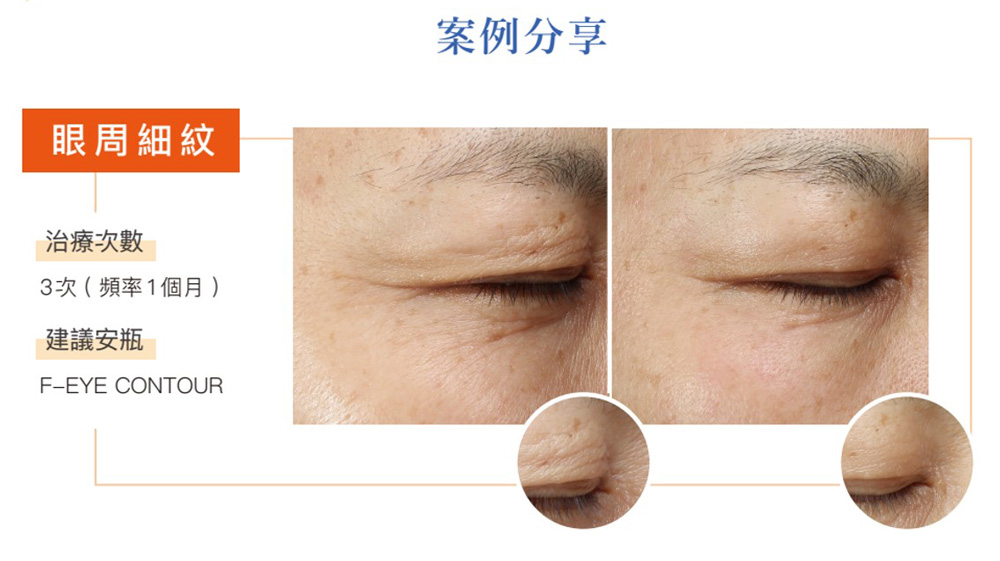 提可塑淡化眼周細紋效果