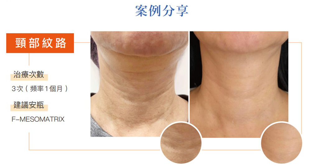 提可塑撫平頸部紋路