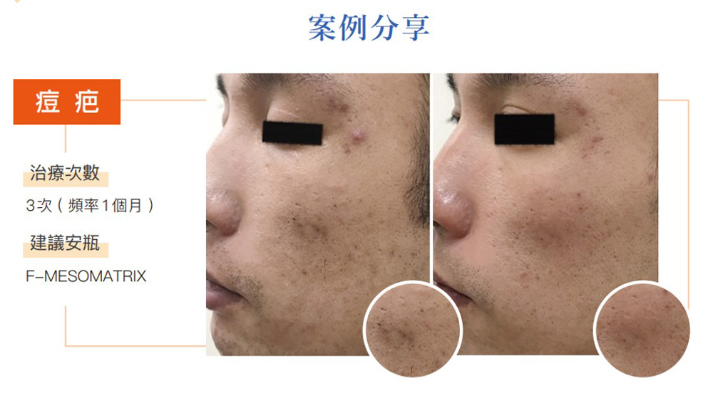 提可塑淡化痘疤