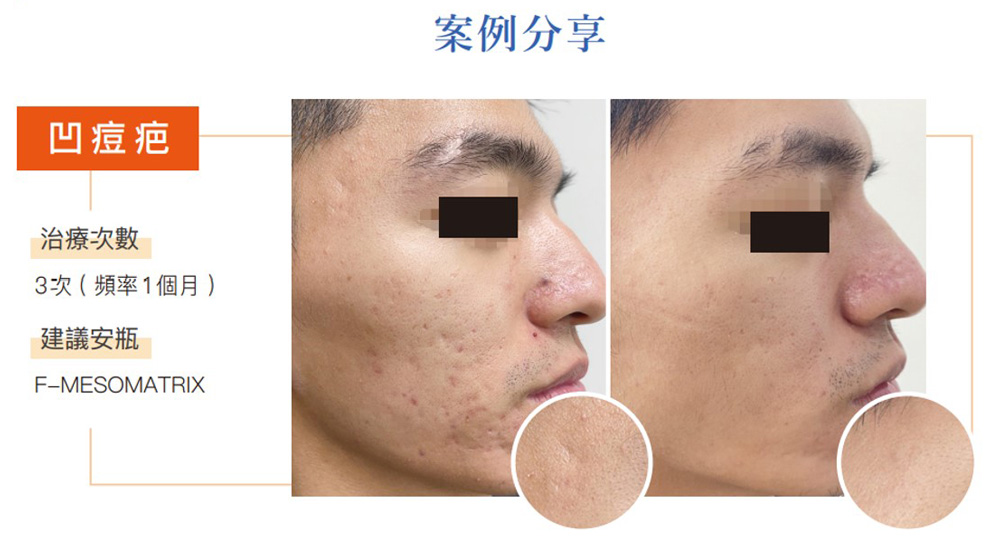 提可塑改善凹痘疤
