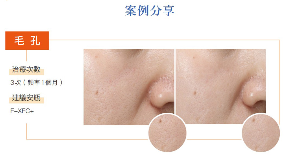 提可塑緊緻毛孔效果